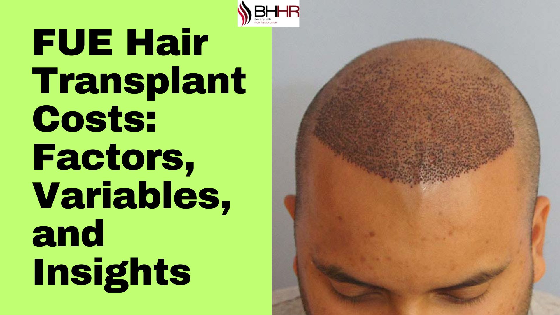 FUE Hair Transplant Costs: Factors, Variables, and Insights