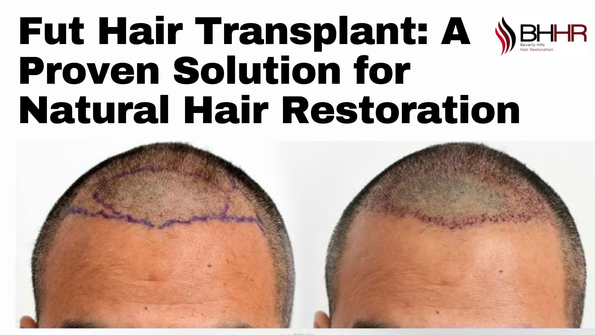 Fut hair transplant BHHR