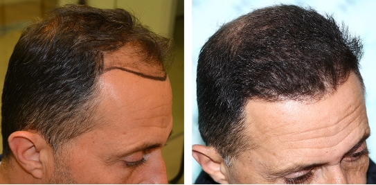 hair transplant results month by month