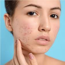 Renewing Confidence: The Path to Acne Scar Treatment in Islamabad"