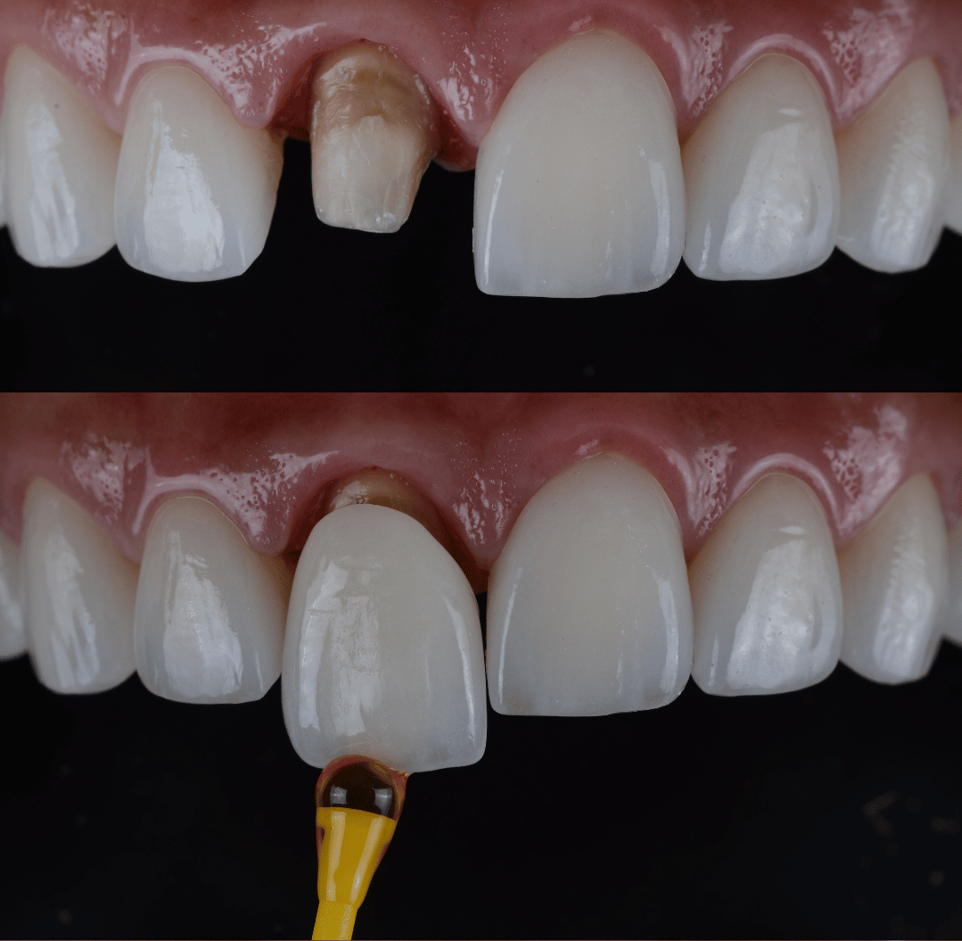 crowns on front teeth before and after