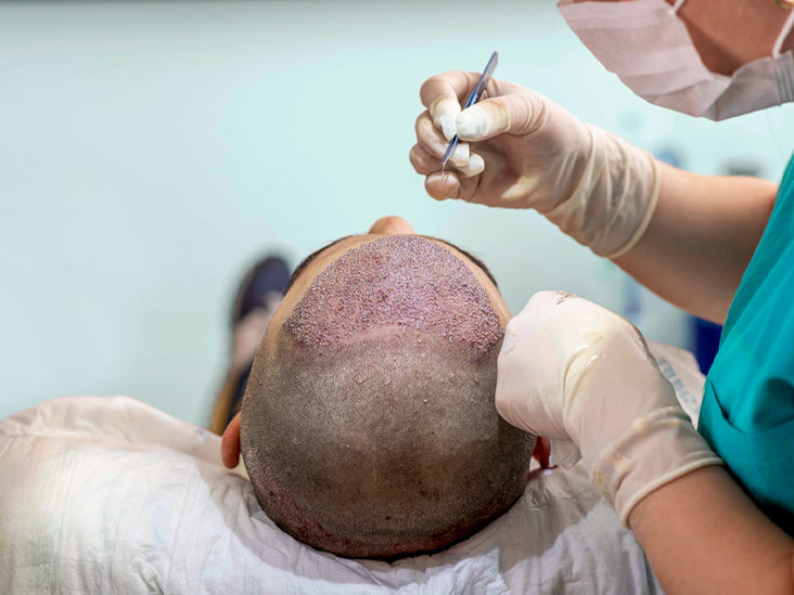 Deciphering Hair Transplant Prices: What You Need to Know