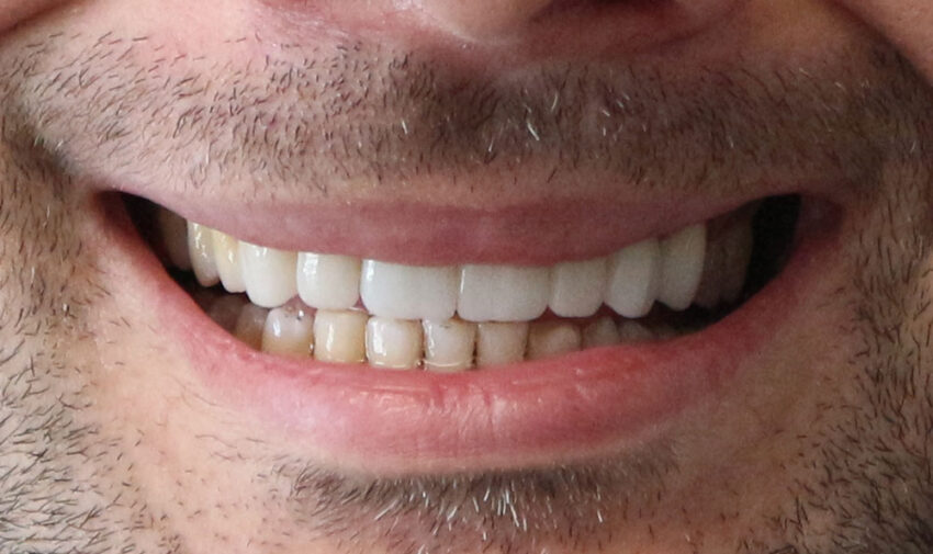 teeth whitening houston